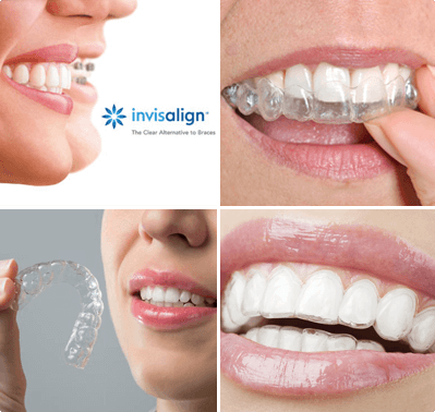 Invisalign, marca de alinhadores transparentes recomendada por dentistas